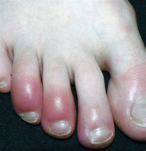 Why Are My Toes Red Causes Other Symptoms And Treatments