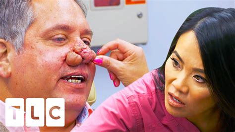 Man Struggling To Breath With His Severe Rhinophyma Dr Pimple Popper