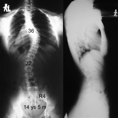 Standing Ap And Lateral Radiographs Of The Patient From The Figure 3