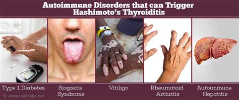 Autoimmune Thyroiditis