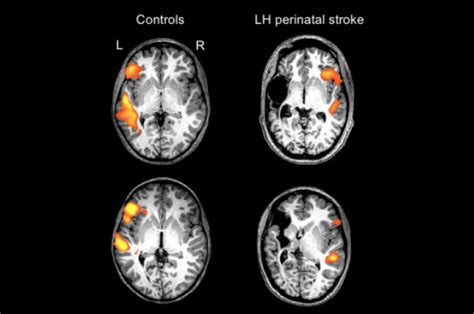 Newborn Stroke Impacts Brain Know The Truth Behind This