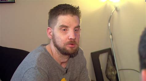 Man Gets Face Transplant After Suicide Attempt Cnn Video