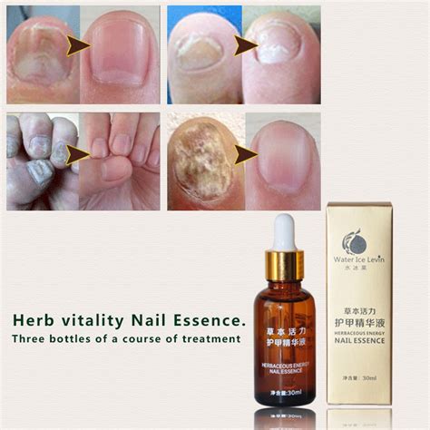 Chinese Medicine Herbs Toe Nail Fungus Treatment Anti Fungal Nail