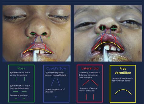 The Unilateral Cleft Lip Cleft Lip Surgical Outcomes Evaluation Scale