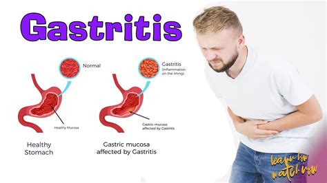 What Is Gastritis Symptoms Types Causes Treatments Images