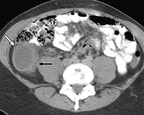 Ct Diagnosis Of Mucocele Of The Appendix In Patients With Acute