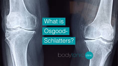 Osgood Schlatters Disease Symptoms Causes And Treatments