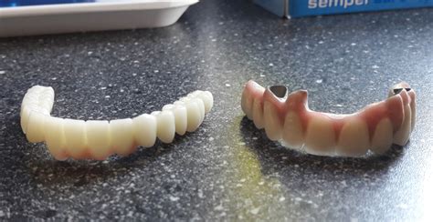 Couronnes dentaires en Hongrie Zircone ou céramique