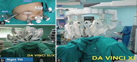 Robot Assisted Retroperitoneal Lymph Node Dissection For Pos