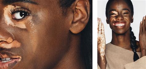 Pin By Åsa Dahlgren On Vitiligo In 2020 Vitiligo Makeup Vitiligo