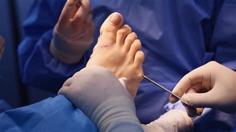 Tailors Bunion Surgery With Screws A Powerful Solution