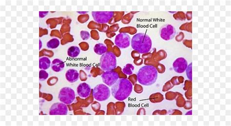 Download When The Leukemia Cells Crowd Out Your Normal Cells Blast