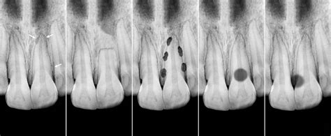 Pathological Resorption Of Teeth Dental Trauma Guide