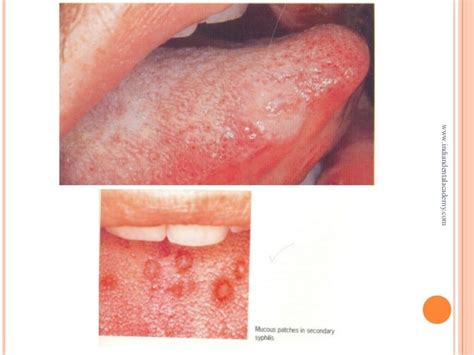 Bacterial Infection Of Oral Cavity