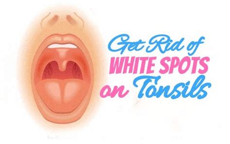 How To Get Rid Of White Spots On Tonsils How To Get Rid Of