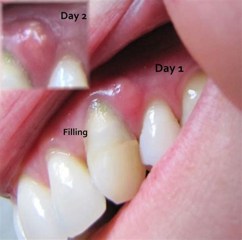 In the beginning stages, a gum abscess appears as a red swelling with a shiny, smooth surface. Gum abscess - An infection begins in the pocket of space ...