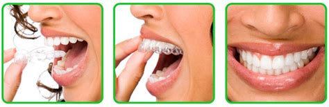They are ceramic or porcelain shells, customized to fit and bonded to the front surfaces of your teeth. Teeth Straightening Without Braces (Tru-Line) Cardiff ...