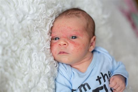 Baby Acne Causes And Treatments My Babys Heartbeat Bear