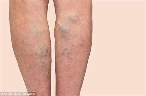Varicose Veins May Be A Warning Sign Of Deadly Blood Clots