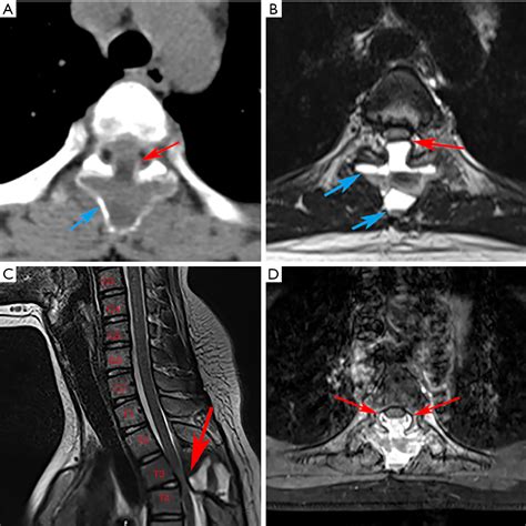An Aneurysmal Bone Cyst Ruptured And Compressed The Spinal Cord A Case