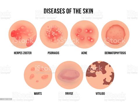 Skin Disease Types Of Dermatology Problems With Names Stock