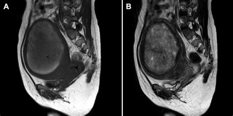 T1 Weighted A And T2 Weighted B Images Showing A 10 Cm Tumor On The