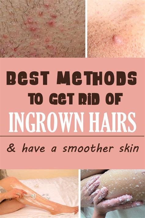 Ingrown Hairs What They Are And How To Get Rid Of Them Missingbeauty