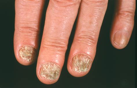 Nail Fungus Dermatologist In New City Ny Scott Sanders Dermatology