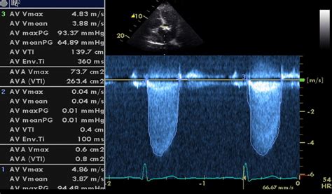 Aortic Stenosis And Doppler Imaging Rhythm Makes A Difference
