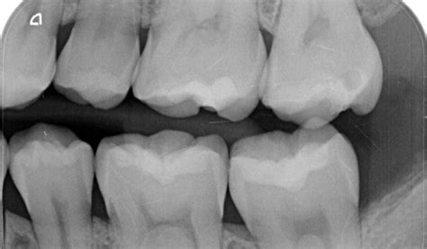 Re Establishing A Stable Occlusion In A Tipped Second Molar