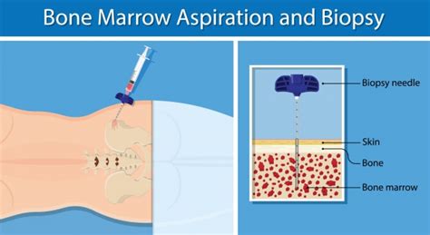 Bone Marrow Aspiration and Biopsy | OncoLink