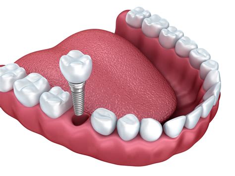 Dental Implants Springfield Nj Permanent Tooth Replacement