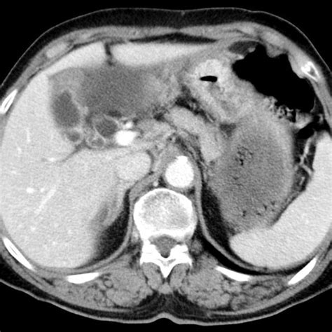 Ct Scan Of Abdomen It Showed A Focal Gallbladder Wall Thickening And