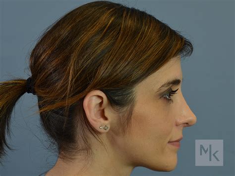 Rhinoplasty Revision Before And After 10 Dr Michael Kim