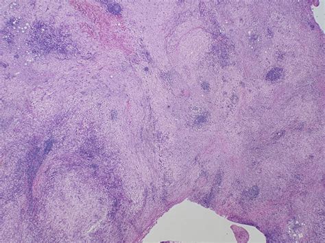 Rosai Dorfman Disease An Overview Journal Of Clinical Pathology