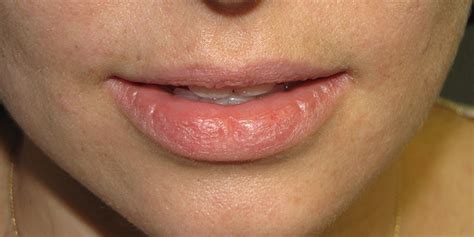 Actinic Cheilitis Skin Cancer And Reconstructive Surgery Center