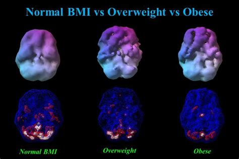 Obesity Reduces Blood Flow To The Brain Increasing Risk To Alzheimer S Disease Phillyvoice