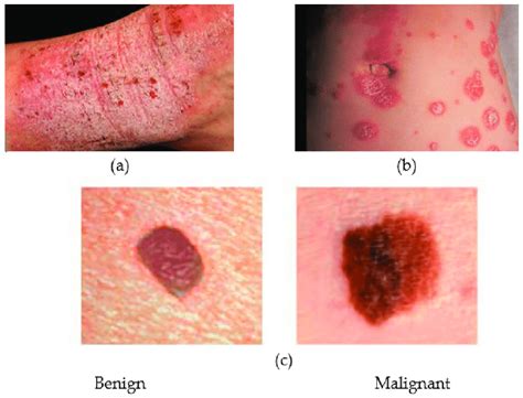 Several Types Of Skin Diseases A Eczema B Psoriasis And C Two