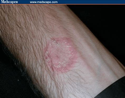 Fungal Skin Infection