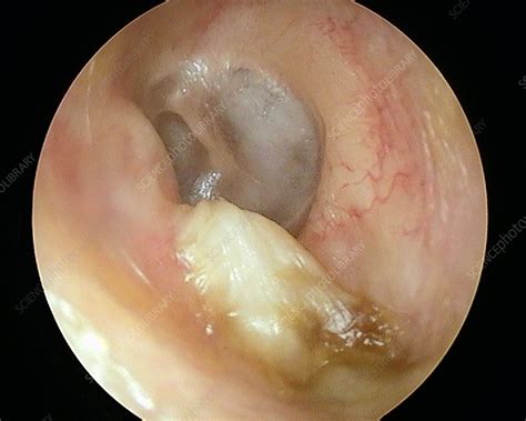 It may develop when water, dirt or other debris gets into the ear canal. Cholesteatoma of the ear canal, otoscope view - Stock ...