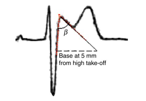 The higher the deflection, the greater the amount of. Dr. Smith's ECG Blog: Is this Type 2 Brugada syndrome/ECG ...