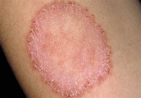 Infeksi Jamur Kulit Ringworm Penyebab Gejala Dan Tips Mencegah