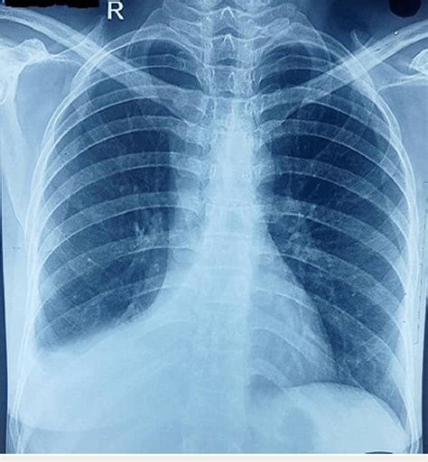 Chest Radiograph Showing Elevated Right Hemidiaphragm And Silhouetting