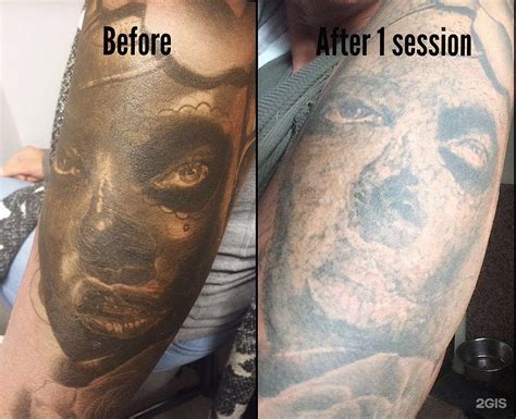 Удаление татуировок до и после фото