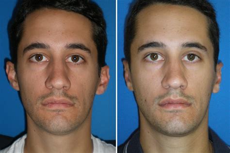 Ear Surgery For Men Richmond Va Cosmetic Facial Surgery