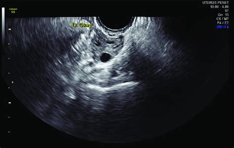 Day 2 Scan Showing Three Follicles In The Right Ovary Before