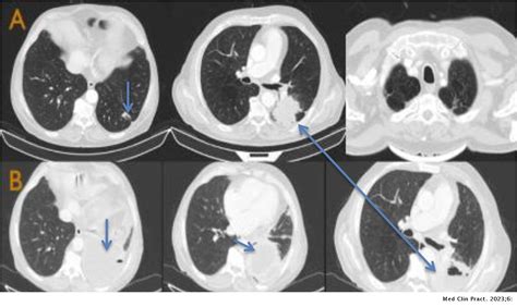 Invasive Actinomycosis And Lung Cancer Study Of Three Cases Medicina