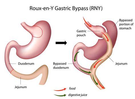 What Is Gastric Bypass Bypass Beauty