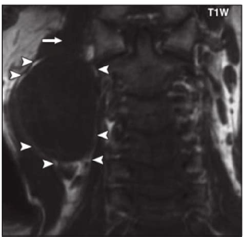 Figure 1 From Common Peroneal Nerve Schwannoma A Rare Cause Of