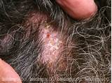 Images of Scalp Ringworm Medication